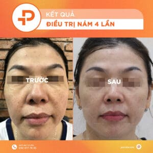 điều trị nám da tại Pensilia