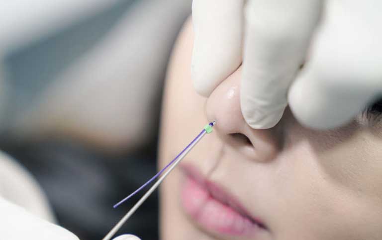 Nâng mũi căng chỉ lên dáng nhẹ nhàng và thanh thoát 